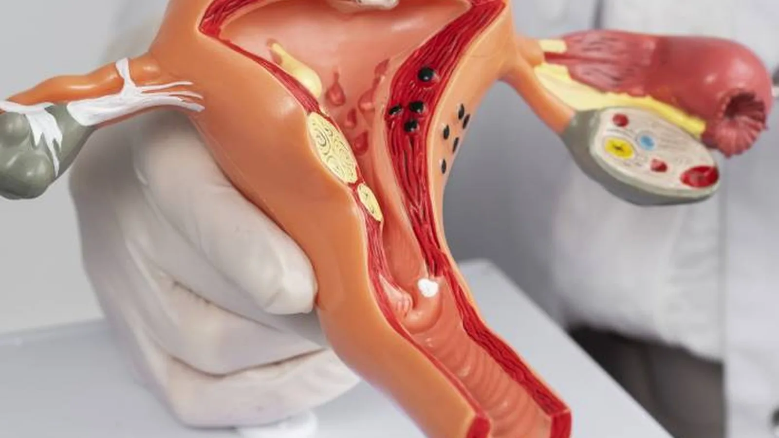 Tratamiento para oncología ginecológica en CDMX y Estado de México